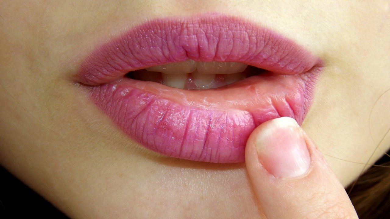 Herpes and cold sore: causes, symptoms, treatment, prevention